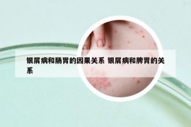 银屑病和肠胃的因果关系 银屑病和脾胃的关系