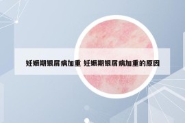 妊娠期银屑病加重 妊娠期银屑病加重的原因