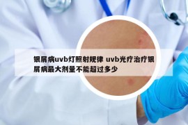 银屑病uvb灯照射规律 uvb光疗治疗银屑病最大剂量不能超过多少