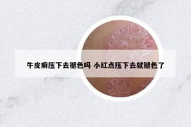 牛皮癣压下去褪色吗 小红点压下去就褪色了