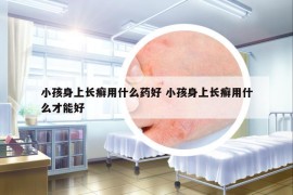 小孩身上长癣用什么药好 小孩身上长癣用什么才能好