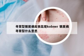 寻常型银屑病皮损出现kobner 银屑病寻常型什么意思