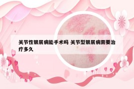 关节性银屑病能手术吗 关节型银屑病需要治疗多久