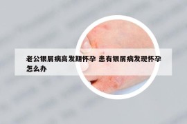 老公银屑病高发期怀孕 患有银屑病发现怀孕怎么办