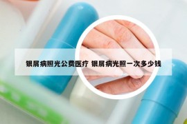 银屑病照光公费医疗 银屑病光照一次多少钱