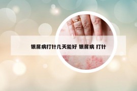 银屑病打针几天能好 银屑病 打针