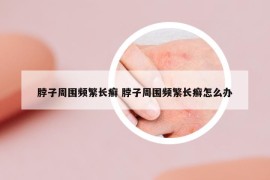 脖子周围频繁长癣 脖子周围频繁长癣怎么办