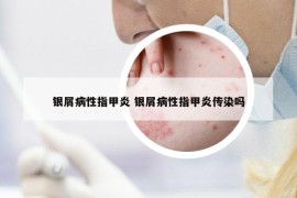 银屑病性指甲炎 银屑病性指甲炎传染吗