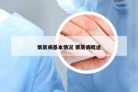 银屑病基本情况 银屑病概述