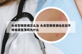 头皮型银屑病怎么治 头皮型银屑病治愈后不吸烟易复发吗为什么