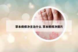 草本癣痒净主治什么 草本癣痒净图片