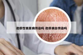 孢疹性银屑病传染吗 孢疹病会传染吗