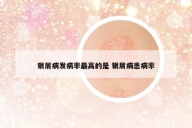 银屑病发病率最高的是 银屑病患病率