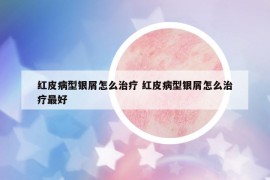 红皮病型银屑怎么治疗 红皮病型银屑怎么治疗最好