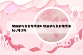 银屑病吃复合维生素b 银屑病吃复合维生素b片可以吗