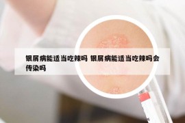 银屑病能适当吃辣吗 银屑病能适当吃辣吗会传染吗