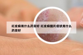 红皮癣用什么药膏好 红皮癣图片症状用什么药膏好