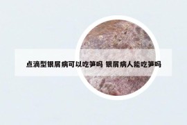 点滴型银屑病可以吃笋吗 银屑病人能吃笋吗