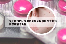 金花转移因子胶囊银屑病可以用吗 金花转移因子胶囊怎么样