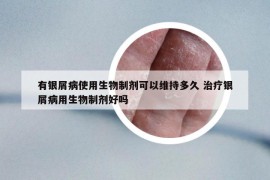 有银屑病使用生物制剂可以维持多久 治疗银屑病用生物制剂好吗