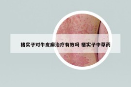 楮实子对牛皮癣治疗有效吗 楮实子中草药