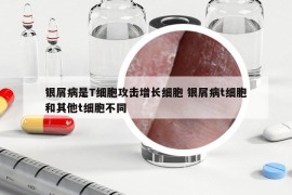 银屑病是T细胞攻击增长细胞 银屑病t细胞和其他t细胞不同