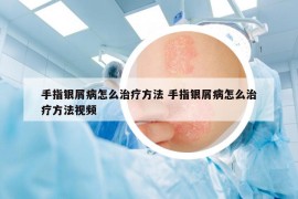 手指银屑病怎么治疗方法 手指银屑病怎么治疗方法视频