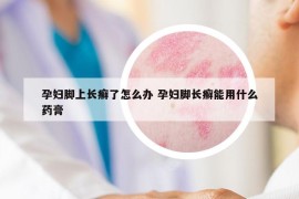 孕妇脚上长癣了怎么办 孕妇脚长癣能用什么药膏