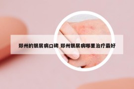 郑州的银屑病口碑 郑州银屑病哪里治疗最好