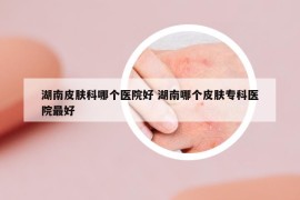 湖南皮肤科哪个医院好 湖南哪个皮肤专科医院最好