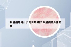 银屑病外用什么药膏效果好 银屑病的外用药物