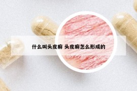 什么叫头皮癣 头皮癣怎么形成的