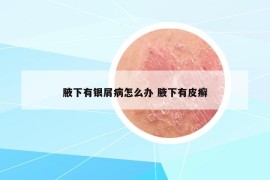 腋下有银屑病怎么办 腋下有皮癣