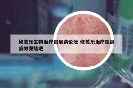 修美乐生物治疗银屑病论坛 修美乐治疗银屑病效果贴吧