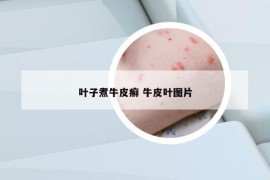 叶子煮牛皮癣 牛皮叶图片