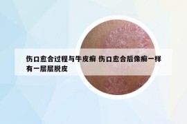 伤口愈合过程与牛皮癣 伤口愈合后像癣一样有一层层脱皮