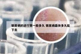 银屑病的进行期一般多久 银屑病最快多久能下去