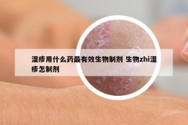 湿疹用什么药最有效生物制剂 生物zhi湿疹怎制剂