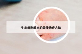 牛皮癣刚起来的最佳治疗方法