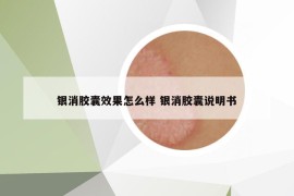 银消胶囊效果怎么样 银消胶囊说明书