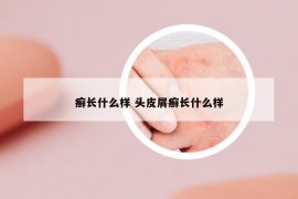 癣长什么样 头皮屑癣长什么样