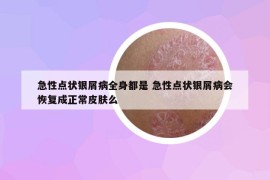 急性点状银屑病全身都是 急性点状银屑病会恢复成正常皮肤么