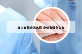 身上有藓会怎么样 身体有藓怎么办