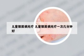 儿童银屑病光疗 儿童银屑病光疗一次几分钟好