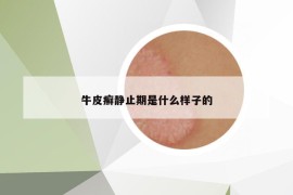 牛皮癣静止期是什么样子的