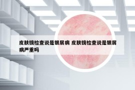 皮肤镜检查说是银屑病 皮肤镜检查说是银屑病严重吗