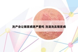 洗产会让银屑病更严重吗 洗澡洗出银屑病