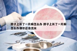 脖子上长了一片癣怎么办 脖子上长了一片癣怎么办偶尔还会流水