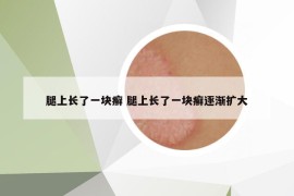 腿上长了一块癣 腿上长了一块癣逐渐扩大