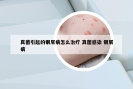 真菌引起的银屑病怎么治疗 真菌感染 银屑病